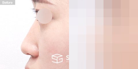 슈가성형외과 첫) 콧대 + 코끝 + 매부리 + 절골 + 비중격연장 + 귀연골 전후사진 - 45도 수술 전후 비교