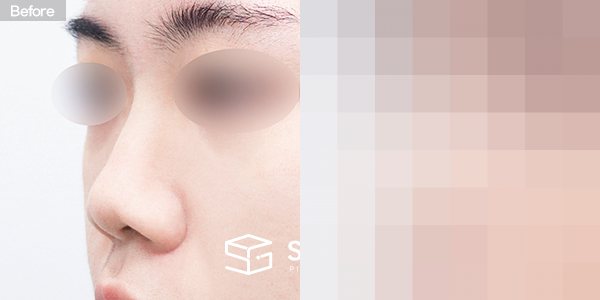 슈가성형외과 첫) 콧대 + 코끝 + 복코 + 콧볼축소 + 비중격연장 + 기증늑 전후사진 - 정면 수술 전후 비교