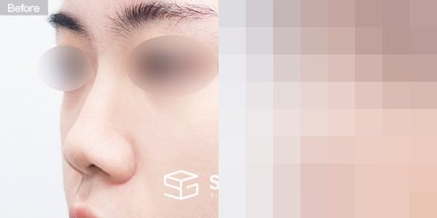 슈가성형외과 첫) 콧대 + 코끝 + 복코 + 콧볼축소 + 비중격연장 + 기증늑 전후사진 - 정면 수술 전후 비교