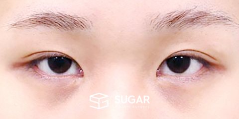 슈가성형외과 재) 재수술 + 자연유착 + 뒤밑트임 전후사진 - 수술 전