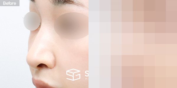 슈가성형외과 재) 재수술 + 무보형물 + 기증늑 + 매부리 + 절골 + 비순각교정 + 귀 뒤 근막 + 콧볼축소 전후사진 - 정면 수술 전후 비교