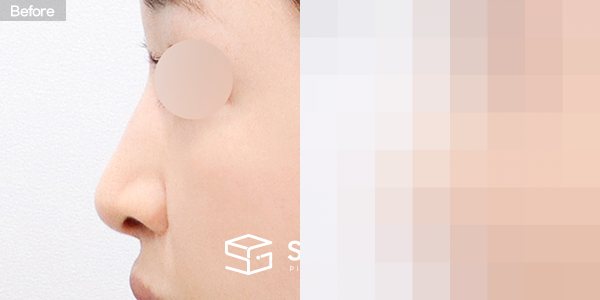 슈가성형외과 재) 재수술 + 무보형물 + 기증늑 + 매부리 + 절골 + 비순각교정 + 귀 뒤 근막 + 콧볼축소 전후사진 - 45도 수술 전후 비교