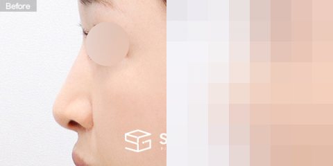 슈가성형외과 재) 재수술 + 무보형물 + 기증늑 + 매부리 + 절골 + 비순각교정 + 귀 뒤 근막 + 콧볼축소 전후사진 - 45도 수술 전후 비교