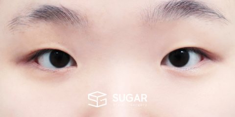 슈가성형외과 첫) 자연유착 + 눈매교정 + 앞트임 전후사진 - 수술 전