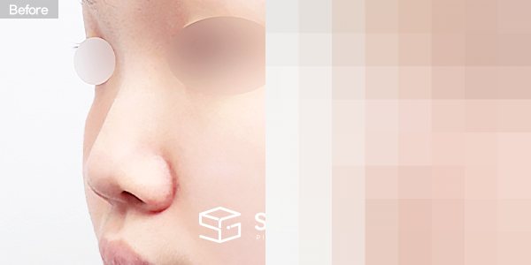슈가성형외과 첫) 콧대 + 코끝 + 복코 + 비주연장 + 콧볼축소 전후사진 - 정면 수술 전후 비교