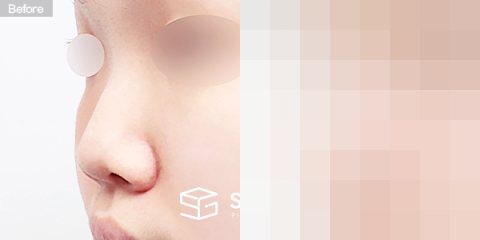 슈가성형외과 첫) 콧대 + 코끝 + 복코 + 비주연장 + 콧볼축소 전후사진 - 정면 수술 전후 비교