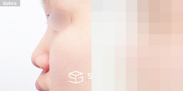 슈가성형외과 첫) 콧대 + 코끝 + 복코 + 비주연장 + 콧볼축소 전후사진 - 45도 수술 전후 비교
