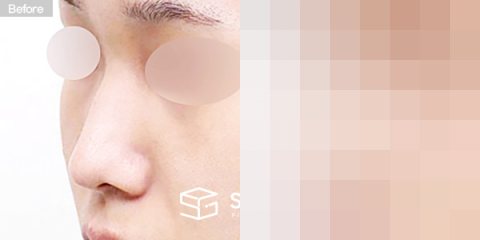 슈가성형외과 첫) 콧대 + 코끝 + 긴코 + 절골 + 귀연골 + 비중격연골 + 매부리 전후사진 - 정면 수술 전후 비교