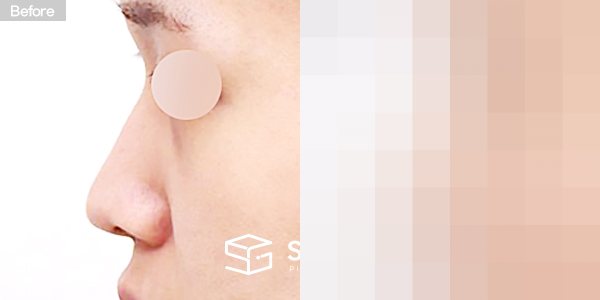 슈가성형외과 첫) 콧대 + 코끝 + 긴코 + 절골 + 귀연골 + 비중격연골 + 매부리 전후사진 - 45도 수술 전후 비교