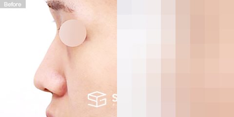 슈가성형외과 첫) 콧대 + 코끝 + 긴코 + 절골 + 귀연골 + 비중격연골 + 매부리 전후사진 - 45도 수술 전후 비교
