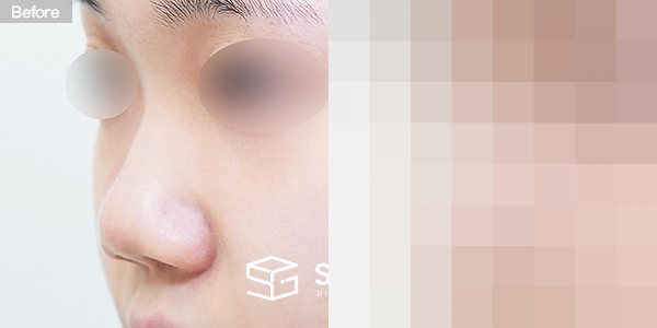 슈가성형외과 첫) 콧대 + 코끝 + 비중격연장 + 복코 + 짧은코 + 비주연장 + 콧볼축소 + 비중격만곡증 전후사진 - 정면 수술 전후 비교