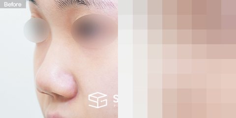 슈가성형외과 첫) 콧대 + 코끝 + 비중격연장 + 복코 + 짧은코 + 비주연장 + 콧볼축소 + 비중격만곡증 전후사진 - 정면 수술 전후 비교