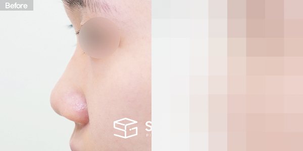 슈가성형외과 첫) 콧대 + 코끝 + 비중격연장 + 복코 + 짧은코 + 비주연장 + 콧볼축소 + 비중격만곡증 전후사진 - 45도 수술 전후 비교