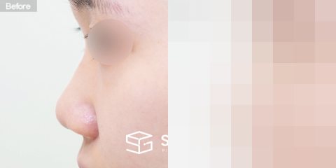 슈가성형외과 첫) 콧대 + 코끝 + 비중격연장 + 복코 + 짧은코 + 비주연장 + 콧볼축소 + 비중격만곡증 전후사진 - 45도 수술 전후 비교