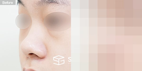 슈가성형외과 첫) 콧대 + 코끝 + 기증늑 + 귀연골 + 짧은코 + 복코 + 콧볼축소 전후사진 - 정면 수술 전후 비교