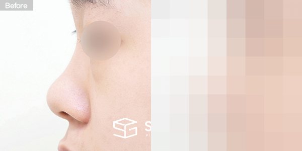 슈가성형외과 첫) 콧대 + 코끝 + 기증늑 + 귀연골 + 짧은코 + 복코 + 콧볼축소 전후사진 - 45도 수술 전후 비교