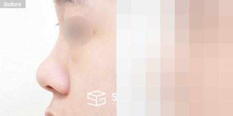 슈가성형외과 첫) 콧대 + 코끝 + 기증늑 + 귀연골 + 짧은코 + 복코 + 콧볼축소 전후사진 - 45도 수술 전후 비교