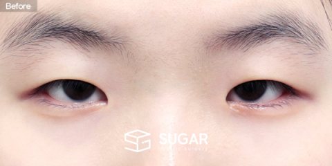 슈가성형외과 첫) 자연유착 + 눈매교정 + 앞트임 전후사진 - 수술 전