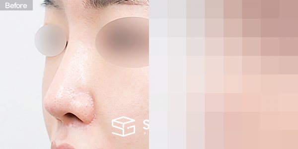 슈가성형외과 재) 재수술 + 콧대 + 코끝 + 기증늑 + 귀연골 + 귀 뒤 근막 전후사진 - 정면 수술 전후 비교