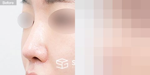 슈가성형외과 재) 재수술 + 콧대 + 코끝 + 기증늑 + 귀연골 + 귀 뒤 근막 전후사진 - 정면 수술 전후 비교