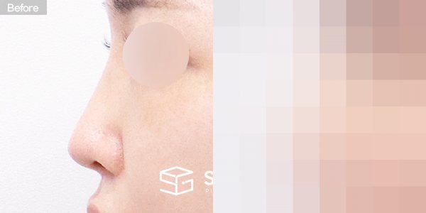 슈가성형외과 재) 재수술 + 콧대 + 코끝 + 기증늑 + 귀연골 + 귀 뒤 근막 전후사진 - 45도 수술 전후 비교