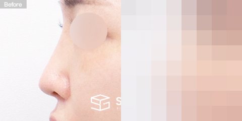 슈가성형외과 재) 재수술 + 콧대 + 코끝 + 기증늑 + 귀연골 + 귀 뒤 근막 전후사진 - 45도 수술 전후 비교