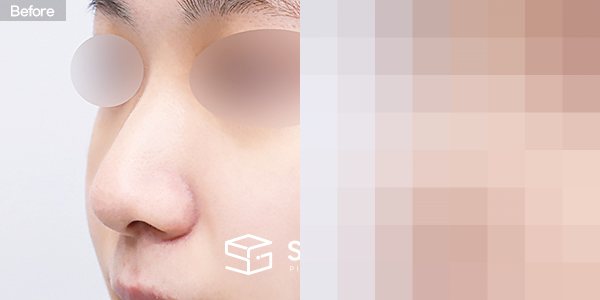 슈가성형외과 첫) 무보형물 + 비중격연골 + 귀연골 + 귀 뒤 근막 + 복코 + 매부리 + 절골 + 비주연장 전후사진 - 정면 수술 전후 비교