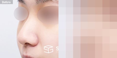 슈가성형외과 첫) 무보형물 + 비중격연골 + 귀연골 + 귀 뒤 근막 + 복코 + 매부리 + 절골 + 비주연장 전후사진 - 정면 수술 전후 비교