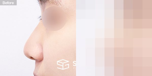 슈가성형외과 첫) 무보형물 + 비중격연골 + 귀연골 + 귀 뒤 근막 + 복코 + 매부리 + 절골 + 비주연장 전후사진 - 45도 수술 전후 비교
