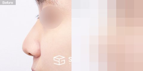 슈가성형외과 첫) 무보형물 + 비중격연골 + 귀연골 + 귀 뒤 근막 + 복코 + 매부리 + 절골 + 비주연장 전후사진 - 45도 수술 전후 비교