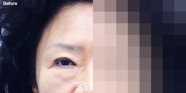 슈가성형외과 첫) 하안검 + 중안면부리프팅 + 이마거상 전후사진 - 정면 수술 전후 비교