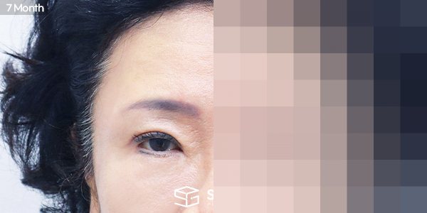 슈가성형외과 첫) 하안검 + 중안면부리프팅 + 이마거상 전후사진 - 45도 수술 전후 비교