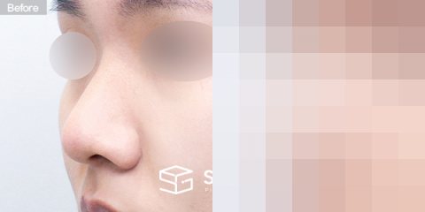 슈가성형외과 첫) 콧대 + 코끝 + 매부리 + 절골 + 복코 + 콧볼축소 + 귀연골 전후사진 - 정면 수술 전후 비교