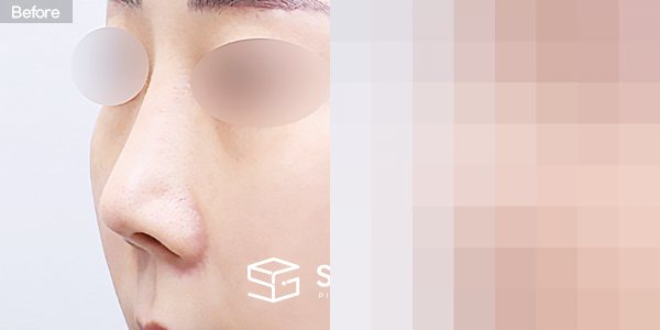슈가성형외과 재) 재수술 + 콧대 + 코끝 + 기증늑 + 비중격연장 + 절골 전후사진 - 정면 수술 전후 비교