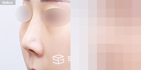슈가성형외과 재) 재수술 + 콧대 + 코끝 + 기증늑 + 비중격연장 + 절골 전후사진 - 정면 수술 전후 비교