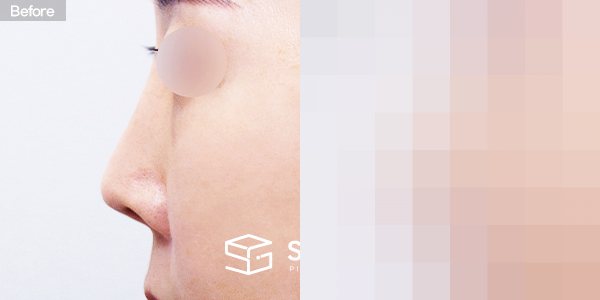 슈가성형외과 재) 재수술 + 콧대 + 코끝 + 기증늑 + 비중격연장 + 절골 전후사진 - 45도 수술 전후 비교