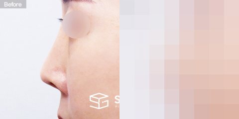 슈가성형외과 재) 재수술 + 콧대 + 코끝 + 기증늑 + 비중격연장 + 절골 전후사진 - 45도 수술 전후 비교