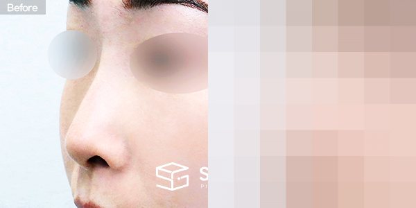 슈가성형외과 첫) 콧대 + 코끝 + 자가늑 + 휜코 + 절골 + 비공내리기 + 비순각교정 전후사진 - 정면 수술 전후 비교