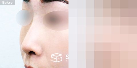 슈가성형외과 첫) 콧대 + 코끝 + 자가늑 + 휜코 + 절골 + 비공내리기 + 비순각교정 전후사진 - 정면 수술 전후 비교