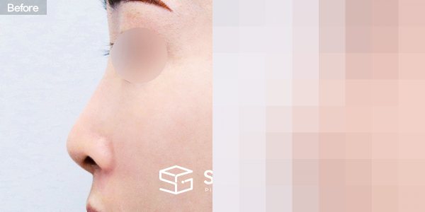 슈가성형외과 첫) 콧대 + 코끝 + 자가늑 + 휜코 + 절골 + 비공내리기 + 비순각교정 전후사진 - 45도 수술 전후 비교