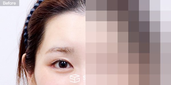 슈가성형외과 첫) 이마거상 전후사진 - 정면 수술 전후 비교
