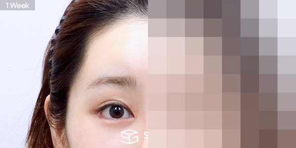 슈가성형외과 첫) 이마거상 전후사진 - 45도 수술 전후 비교
