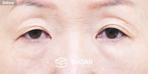 슈가성형외과 첫) 눈매교정 + 눈썹하거상술 + 상안검 + 하안검 + 중안면부거상 전후사진 - 수술 전