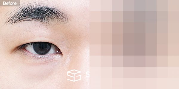 슈가성형외과 첫) 눈밑지방재배치 전후사진 - 정면 수술 전후 비교