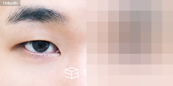 슈가성형외과 첫) 눈밑지방재배치 전후사진 - 45도 수술 전후 비교
