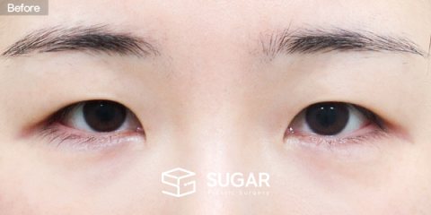 슈가성형외과 첫) 자연유착 + 눈매교정 + 앞트임 전후사진 - 수술 전