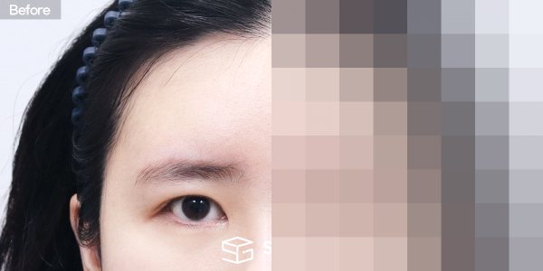 슈가성형외과 재) 자연유착 재수술 + 윗트임 + 뒤밑트임 + 이마거상 전후사진 - 정면 수술 전후 비교