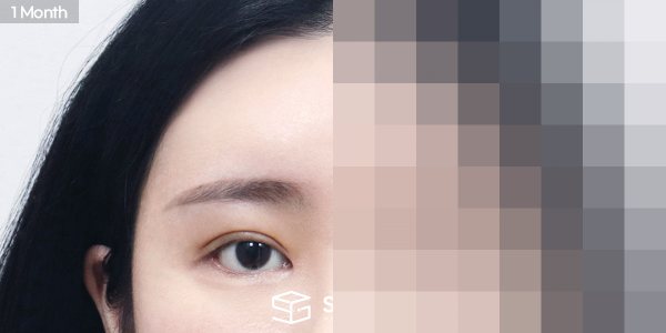 슈가성형외과 재) 자연유착 재수술 + 윗트임 + 뒤밑트임 + 이마거상 전후사진 - 45도 수술 전후 비교