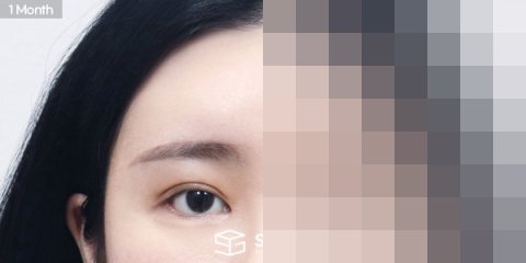 슈가성형외과 재) 자연유착 재수술 + 윗트임 + 뒤밑트임 + 이마거상 전후사진 - 45도 수술 전후 비교