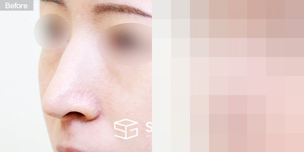슈가성형외과 재) 재수술 + 무보형물 + 긴코 + 휜코 + 매부리 + 절골 + 기증늑 + 귀연골 + 귀 뒤 근막 + 비중격만곡증 전후사진 - 정면 수술 전후 비교